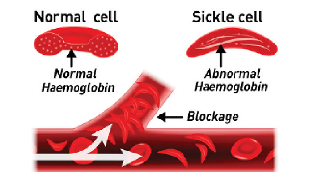 Group seeks govt intervention in sickle cell treatment